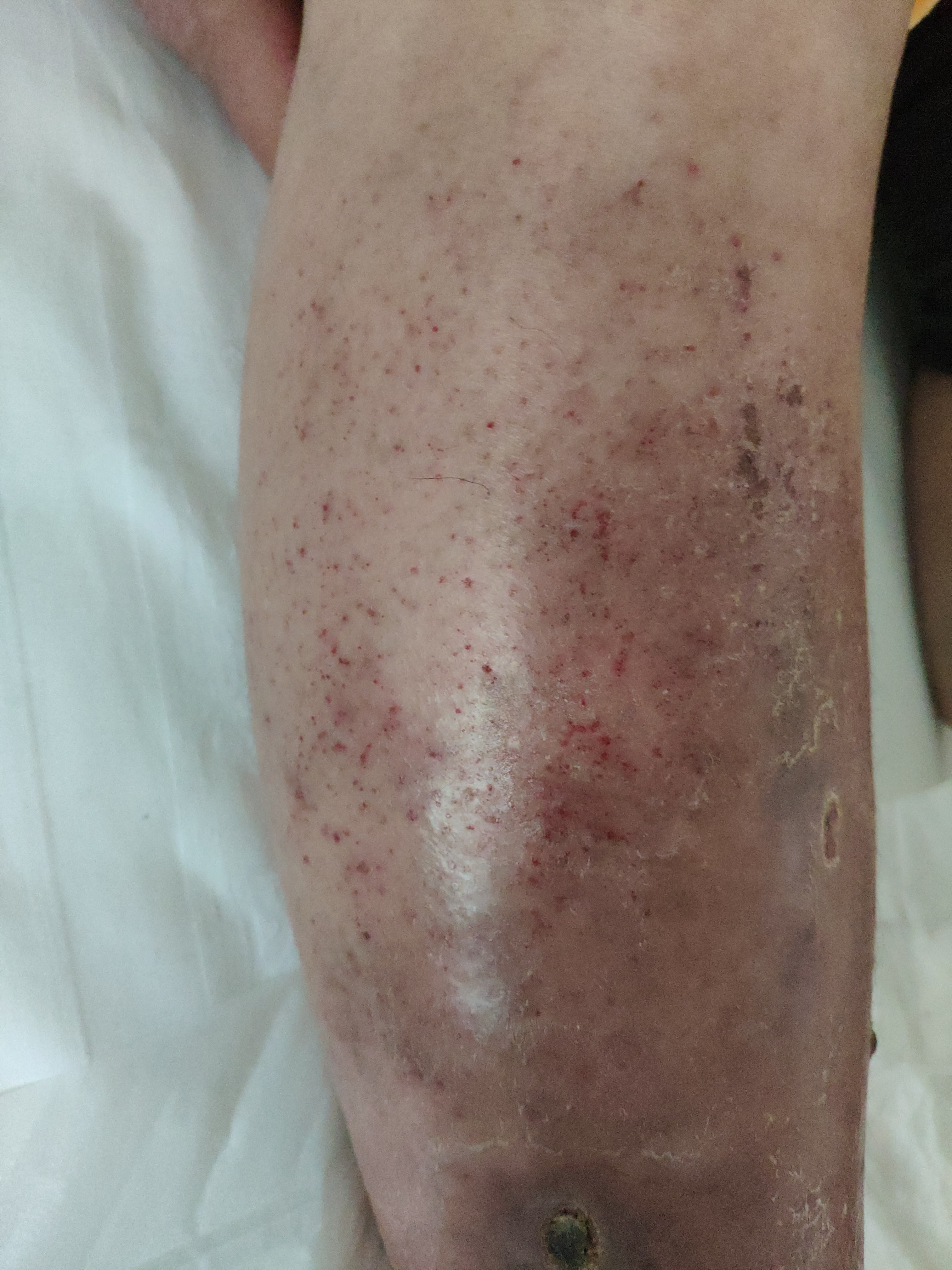 皮肤溃疡长期不愈合挂哪个科,皮肤出水溃烂看什么科