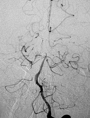 卢旺盛：脉瘤和基底动脉动脉瘤裸栓治疗术后效果非常明显