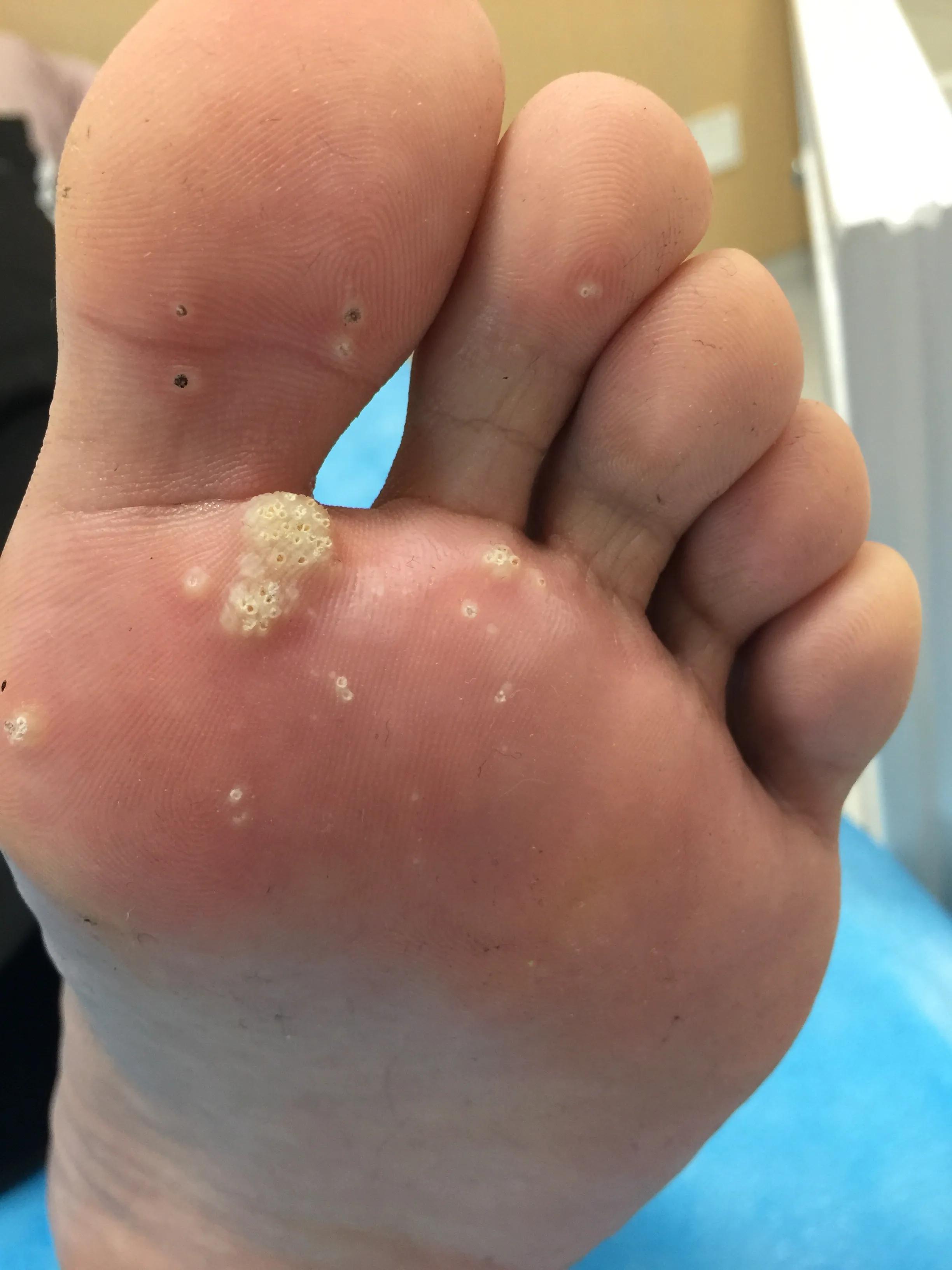 火针治疗跖疣有效果吗,火针点刺治疗跖疣