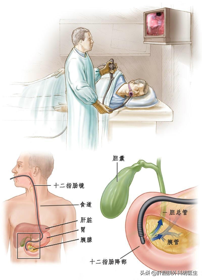 胰腺癌手术后肝转移出现黄疸,胰腺癌出现黄疸是早期还是晚期