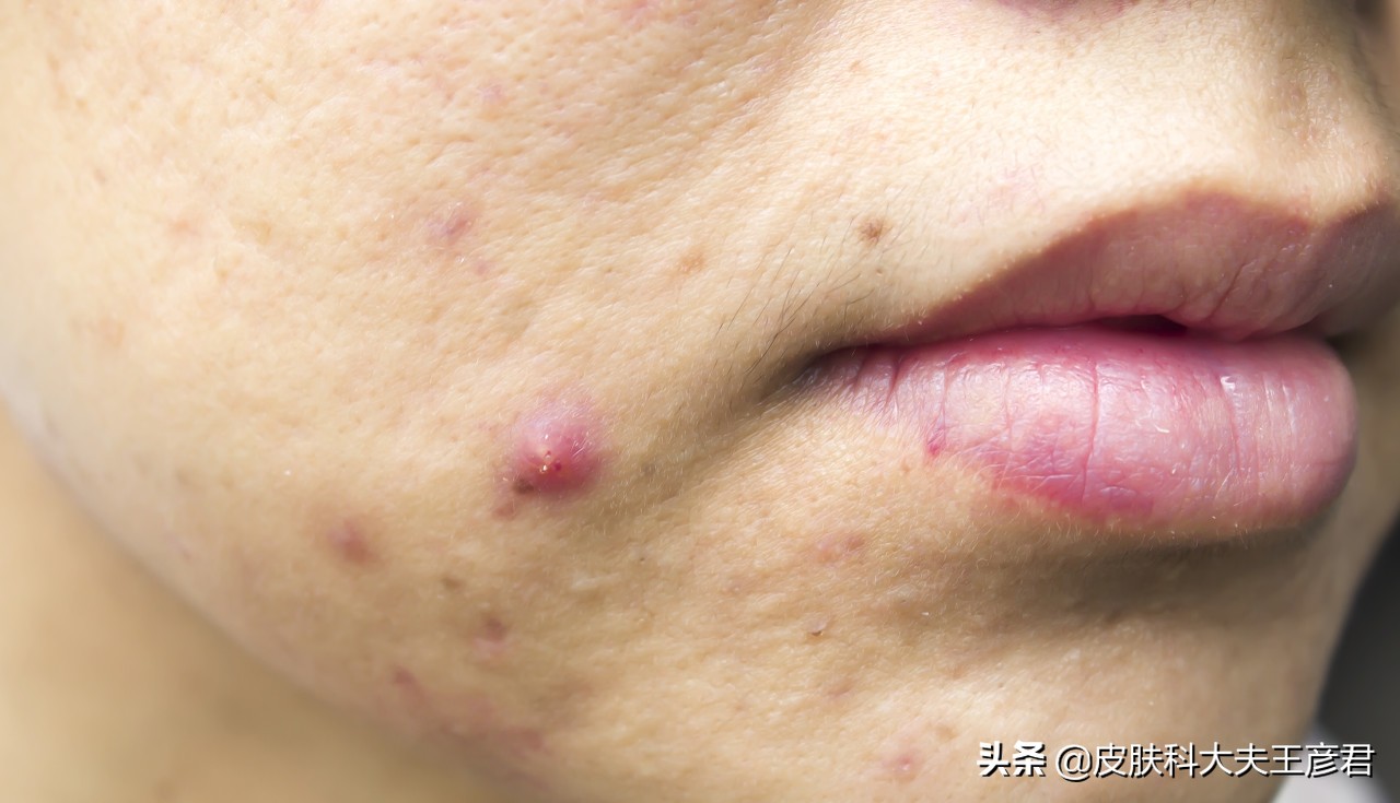 脸上*疮痤**，青春痘，痘痘，粉刺，各类型痘痘的用药指南参考