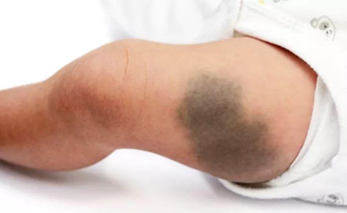 宝宝为什么出生后身上有很多青块,宝宝出生为什么有青胎记