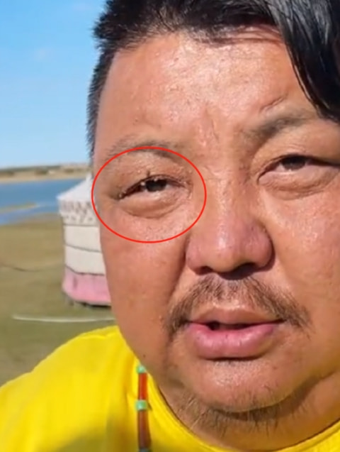 恩克脸上的黑斑,恩克面部频繁出现黑斑