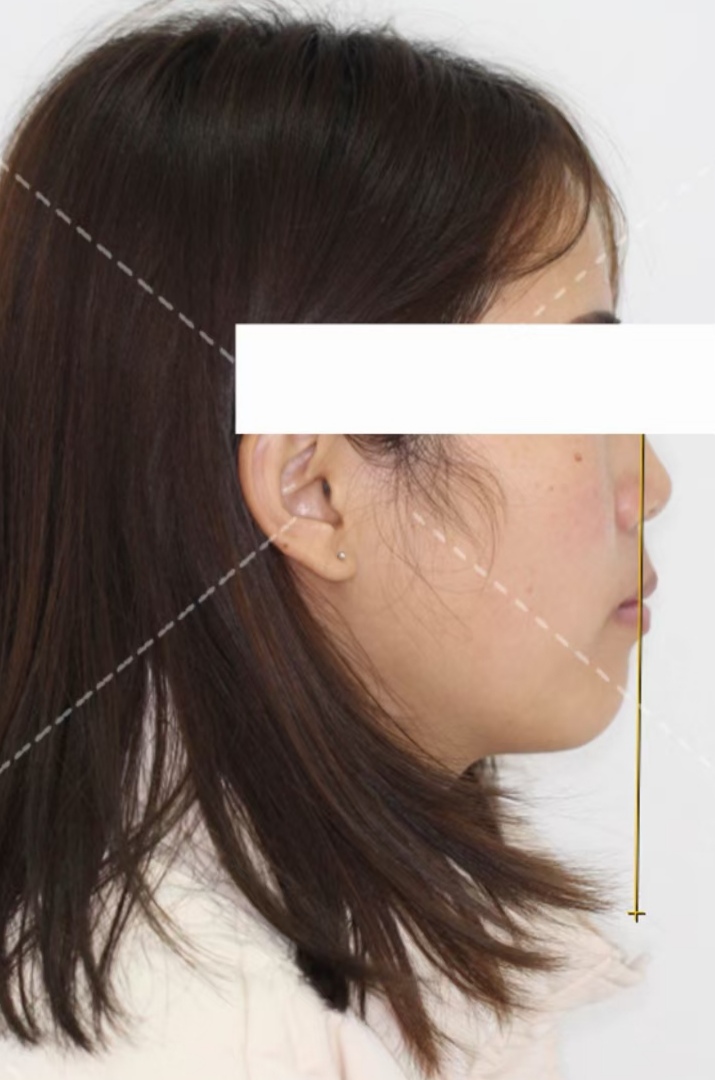 看牙矫正一般去哪里看,矫正牙齿的全套流程