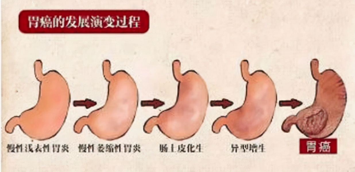 萎缩性胃炎吃羔羊胃还会癌变吗,萎缩性胃炎是胃缩小了吗
