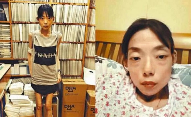 她为嫁豪门放弃牛津，吃*肥药减**致瘫痪体重仅剩44斤，遭夫弃终放下