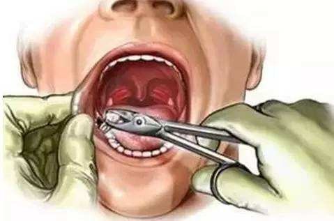 90岁以上老人拔牙好吗,老年人拔牙有哪些注意事项呢