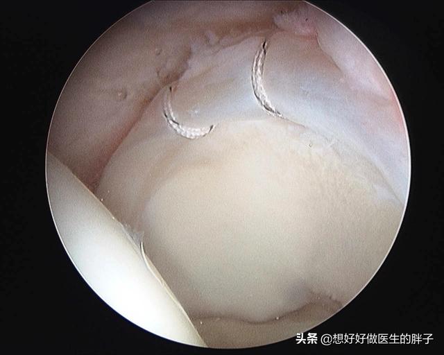 髋关节疼痛会引起腿痛吗,髋关节疼痛两腿不一样长如何康复