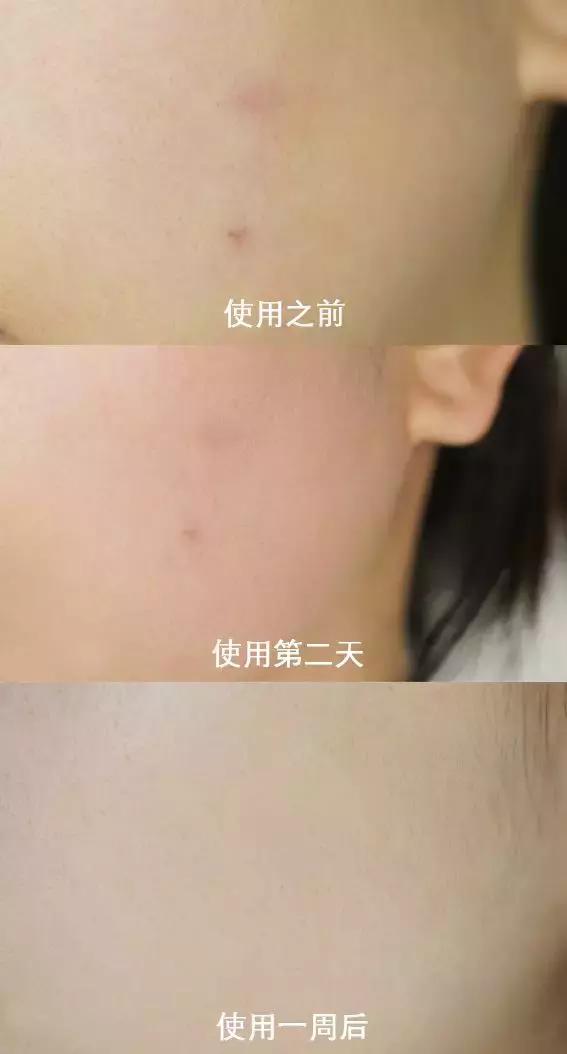 爱“痘”大PK良心测评抗痘神器