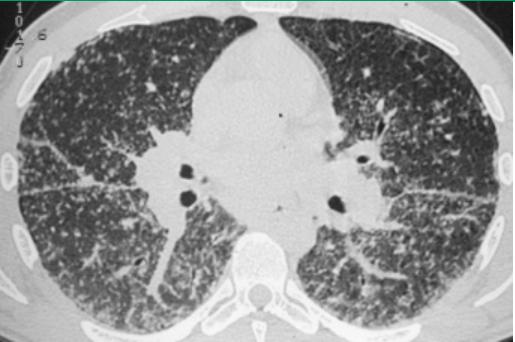 结节病关节痛眼睛模糊,结节病引起的关节炎