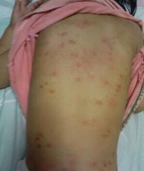 跳蚤的危害及室内灭蚤方法,跳蚤和虱子会传播疾病吗