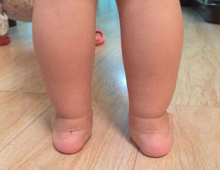 关于儿童足外翻，你误会了多少？后悔科普太晚了