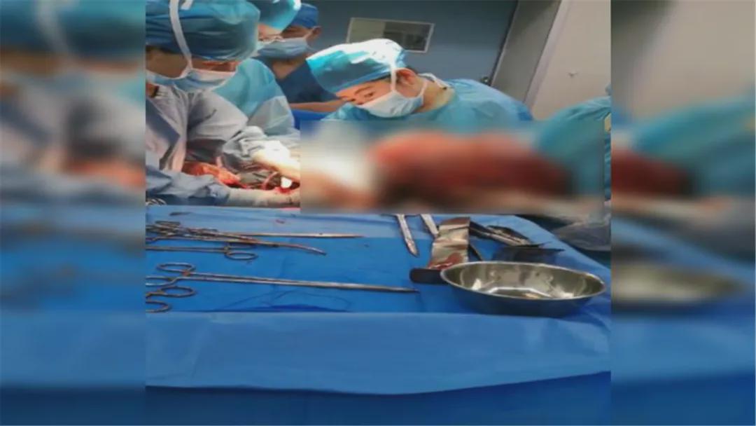 女子腹中取100斤重肿瘤,年轻女子查出大肌瘤