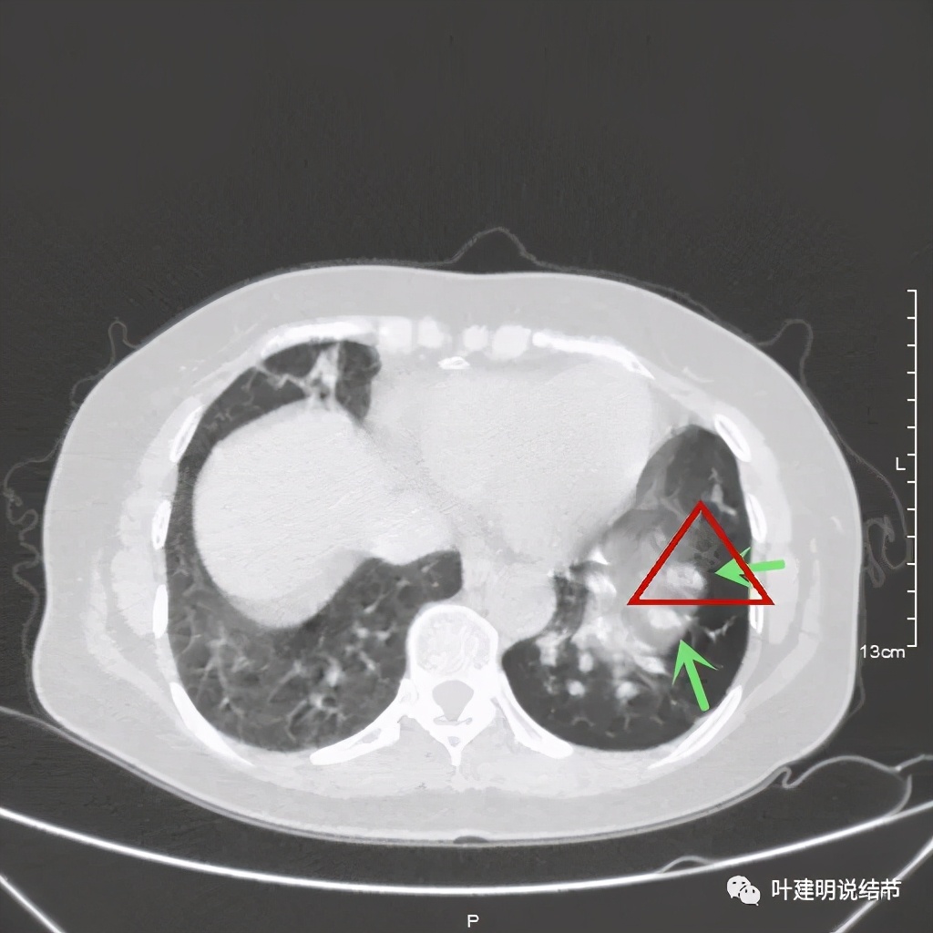 这样的实性结节伴小空洞会是肺癌吗？