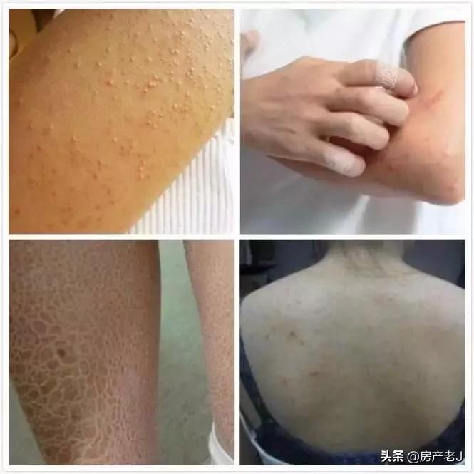 腿上有鱼鳞皮屑怎么办,腿上起皮屑就是鱼鳞病