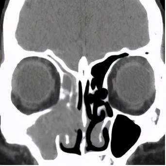头痛眼睛胀痛流鼻涕全身无力,鼻子痛引起头痛眼睛疼是什么原因