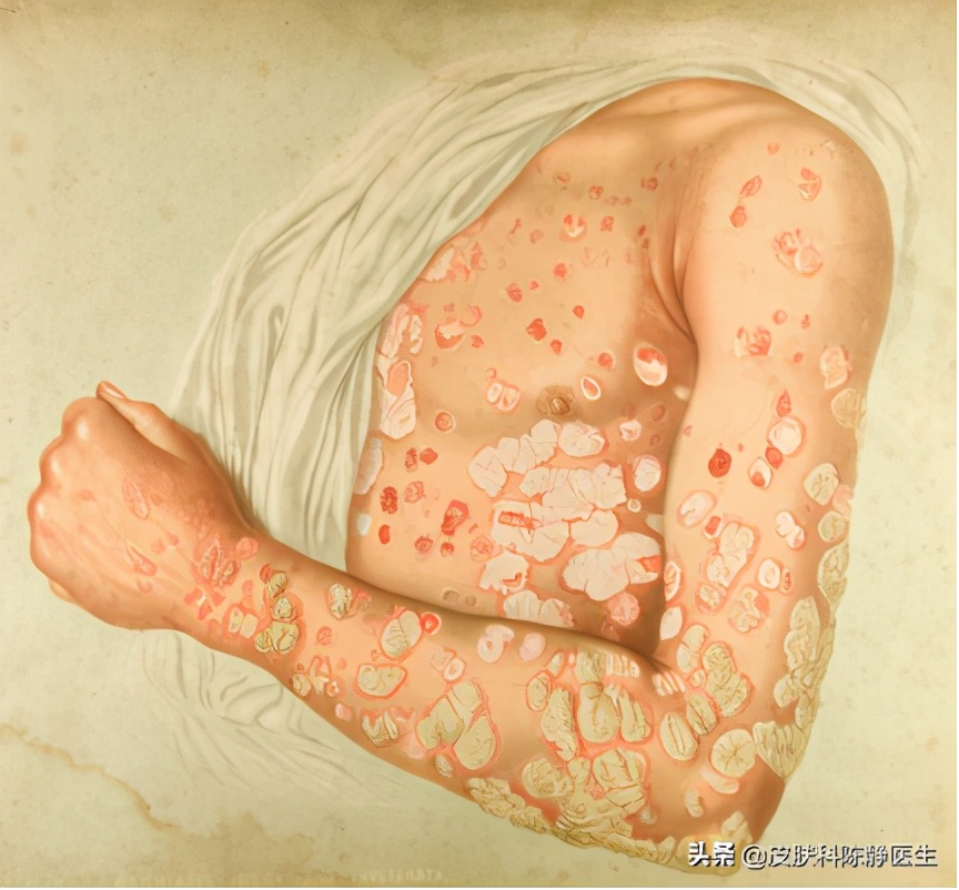 治疗牛皮癣银屑病进口生物制剂,牛皮癣最新生物制剂口服