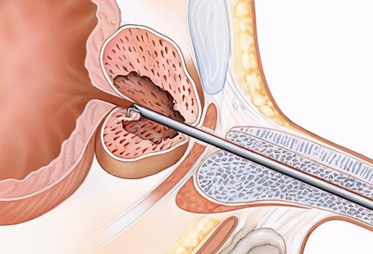 前列腺肥大并钙化灶什么症状,年轻人有前列腺肥大