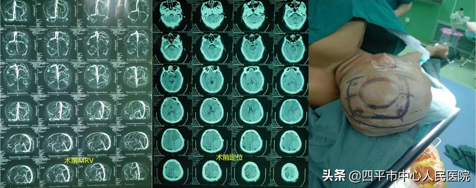 四平市中心医院介入血管外科,颅内胆脂瘤的克星
