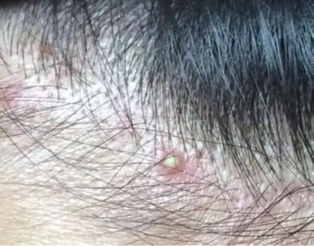 头皮长痘痘怎么办碰了痛,头皮长痘痘怎么办最有效的方法