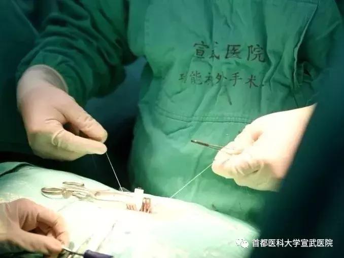 脑瘫儿童微创手术,未来治疗脑瘫重大突破