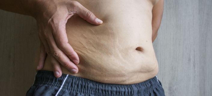 肥胖纹很严重怎么消除,有效去除肥胖纹的方法