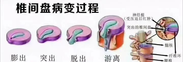 腰腿痛病因病机是什么,腰腿痛的病因全在这里了