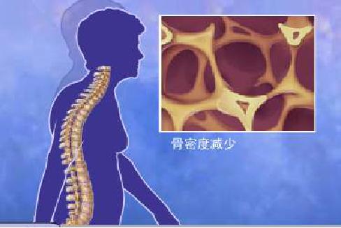 骨质疏松的骨痛有何特点,骨折后骨碎是怎样形成的