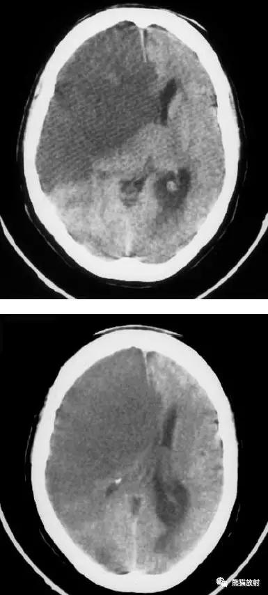 脑梗死丨演变、血供区域分布、CT表现
