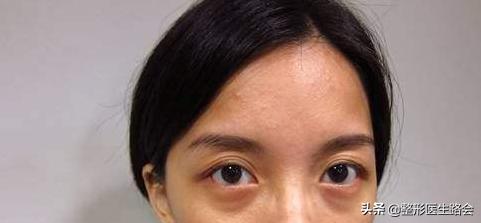 用什么样的眼霜可以缓解泪沟眼袋,眼袋和泪沟用眼霜效果好吗