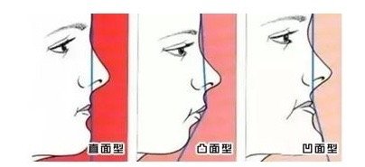 厦门牙齿矫正前后对比,牙齿矫正对脸型的改变有多大知乎