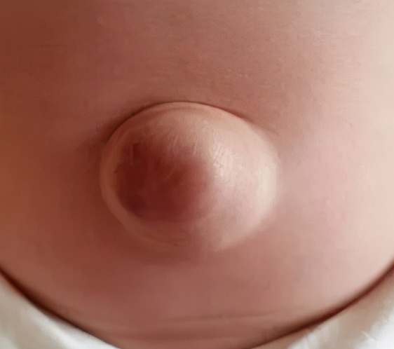 【呱呱叫49】要不要紧?小宝宝哭闹时肚脐会鼓出一个肿块?新手爸妈来学习一下吧!