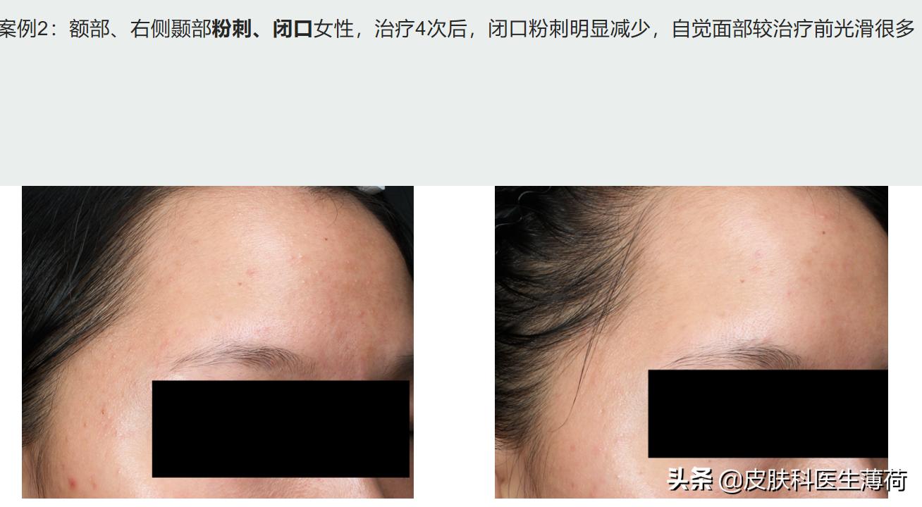 水杨酸果酸毛孔收缩精华测评,水杨酸精华适合所有痘肌