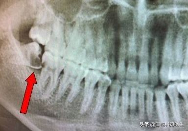 智齿发炎导致淋巴结疼痛肿大,智齿发炎了引起口腔内壁发白疼痛