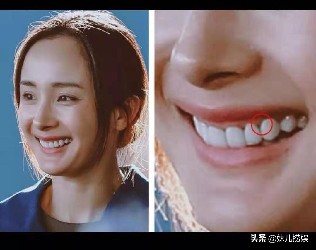 烤瓷牙美白注意事项,烤瓷牙选错颜色有点黄如何美白