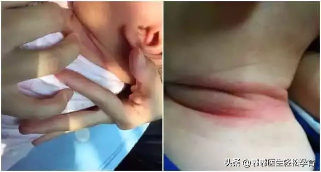 婴幼儿脖子淹了破皮了怎么办,脖子淹破皮了抹香油管用吗