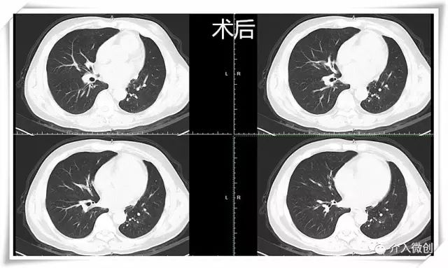 肺神经内分泌癌早期手术好吗,肺部神经内分泌肿瘤治疗