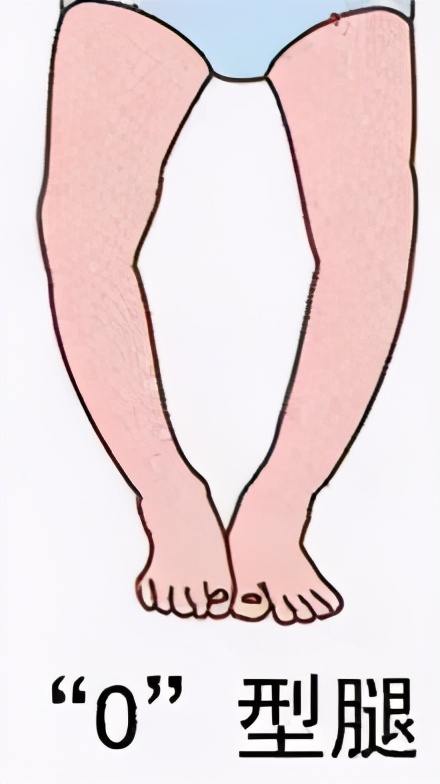 「病例精选」不用换关节，TCVO手术给您新“膝”望