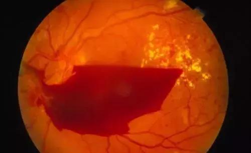 眼前一直有蚊子是什么病,眼前总有蚊子飞怎么治呀