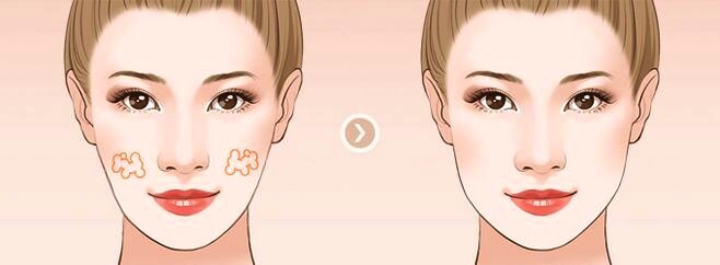 太阳穴脂肪填充术后注意事项,自体脂肪填充术后注意事项