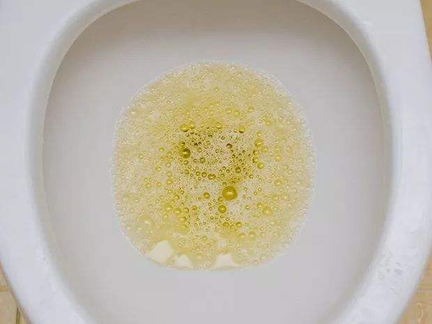 肾病主要是尿频还是尿少,肾病来时静悄悄的4个症状