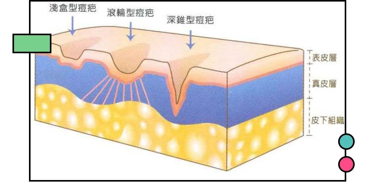 如何祛痘印？看了这篇能解决你大部分的问题！