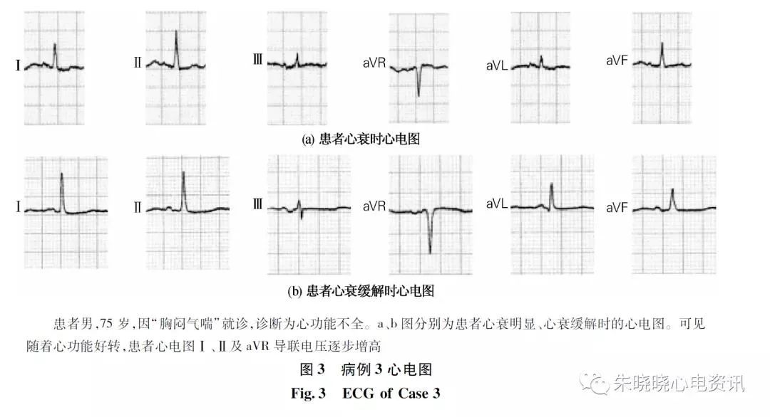 心电图qrs波群是什么意思,心电图中qrs电压怎么看