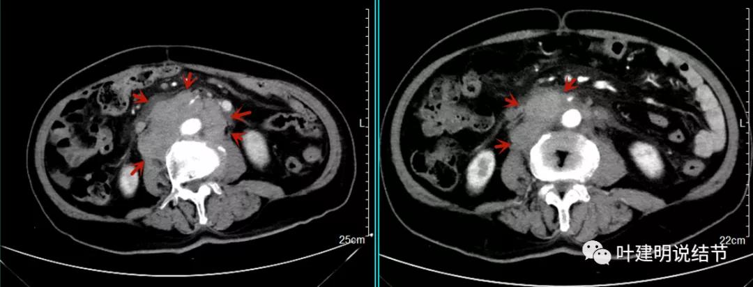 特瑞普利单抗食管癌成功案例,特瑞普利单抗治疗食管癌效果好吗