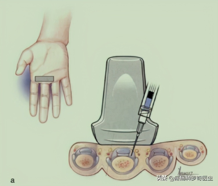 一岁半腱鞘炎最简单自愈方法,腱鞘炎小妙招一招摆脱困扰