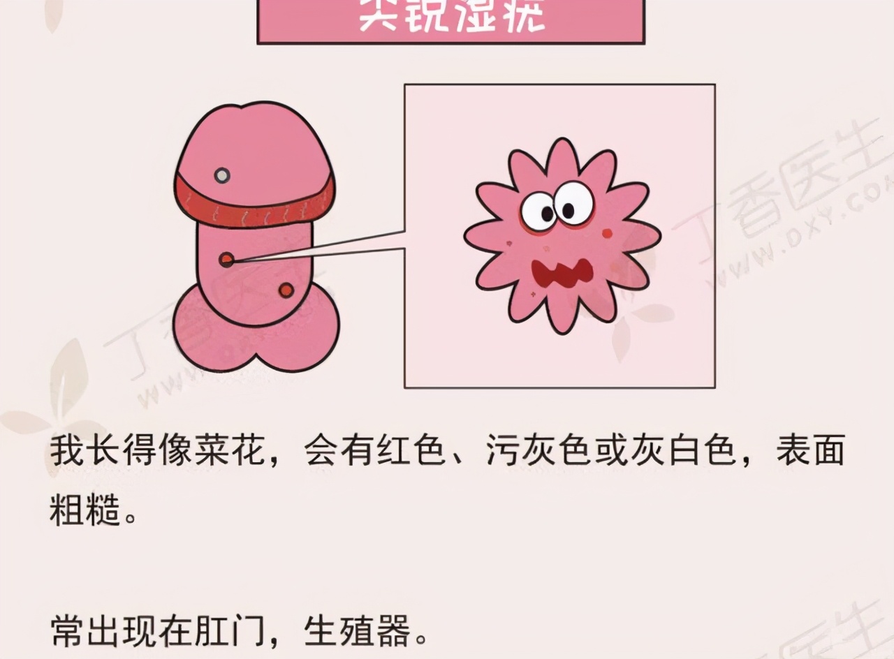 尖锐湿疣的早期症状是什么