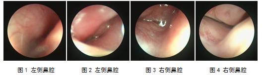 儿童中耳炎吃的怎么是鼻窦炎的药,儿童分泌性中耳炎的外科治疗指征