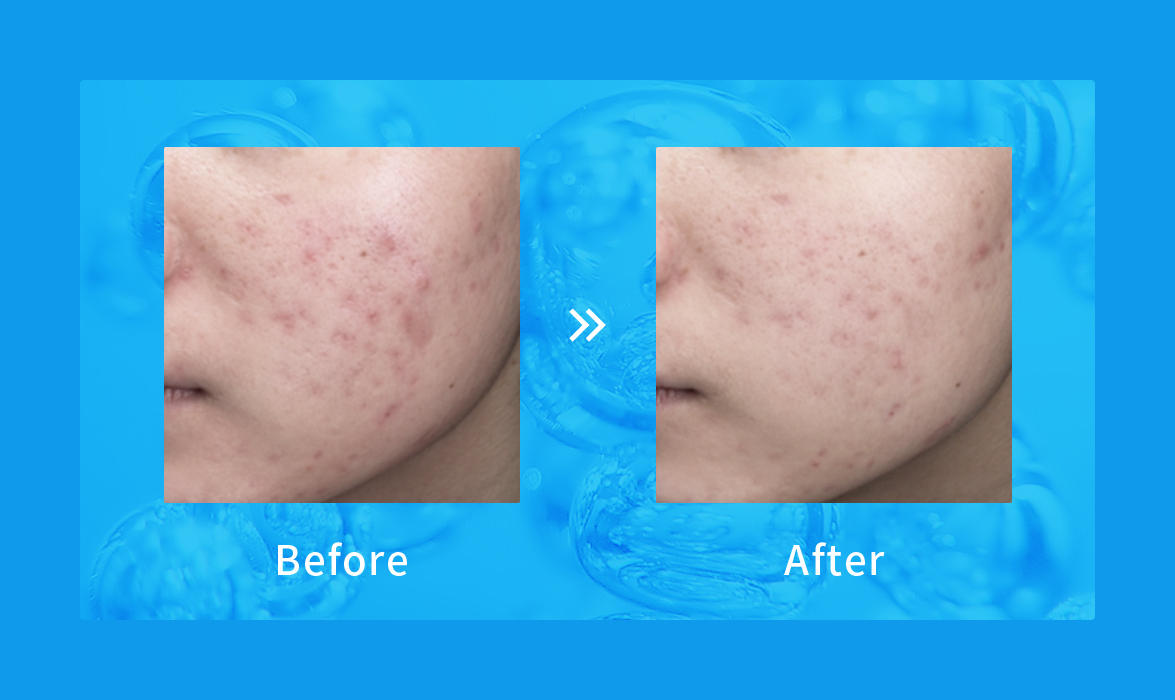 wis二代祛痘修护,wis祛痘全套