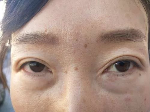 女子整容后惨不忍睹,女子双眼皮整容失败