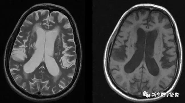 脑室影像学表现,脑室占位影像